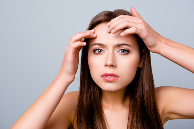 atasi jerawat di kulit kepala